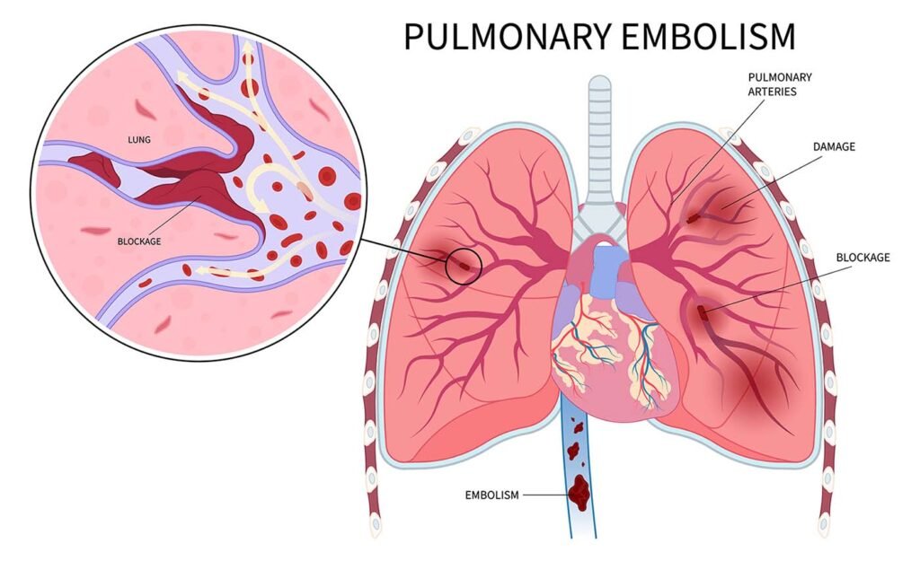Pulmonary Embolism Representation